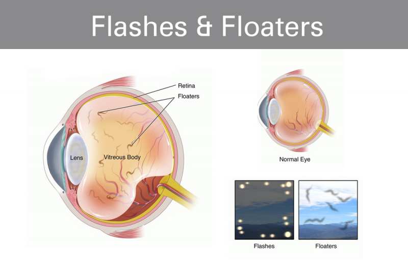 Flashes And Floaters Pediatric Family Eyecare